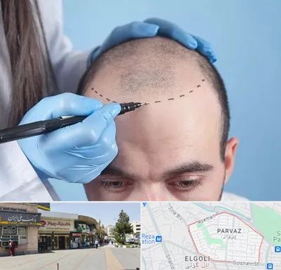 کاشت مو اقساطی در پرواز تبریز