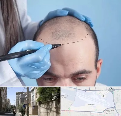 کاشت مو اقساطی در مهرآباد