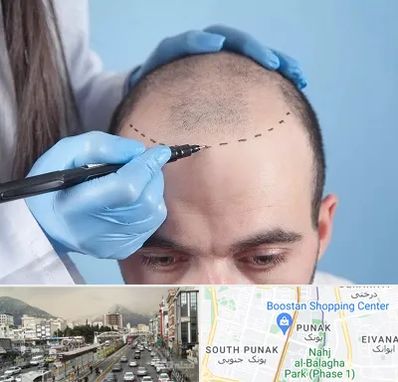 کاشت مو اقساطی در پونک 