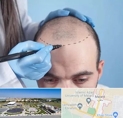 کاشت مو اقساطی در ملارد