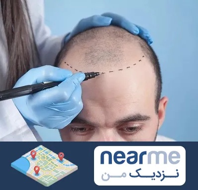 کاشت مو اقساطی در نزدیک من