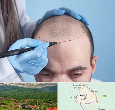 کاشت مو اقساطی در آمل