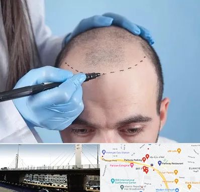 کاشت مو اقساطی در پارک وی 