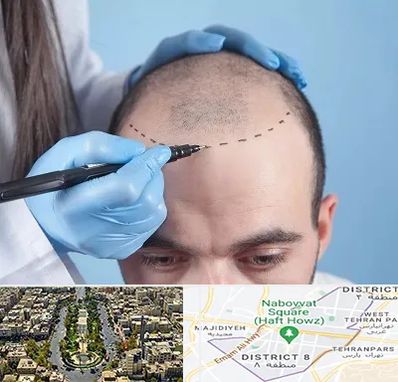 کاشت مو اقساطی در نارمک 