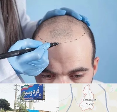 کاشت مو اقساطی در فردوسیه شهریار