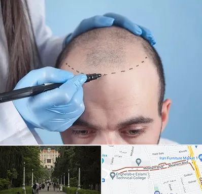 کاشت مو اقساطی در بلوار معلم رشت 