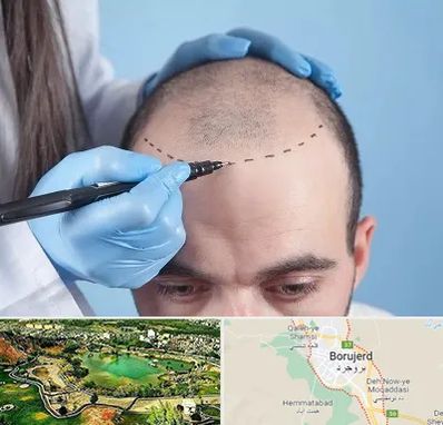 کاشت مو اقساطی در بروجرد