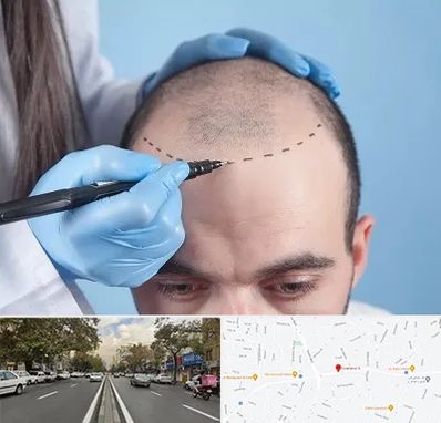 کاشت مو اقساطی در دولت 