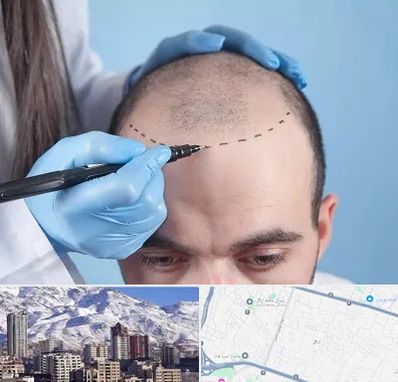 کاشت مو اقساطی در ازگل