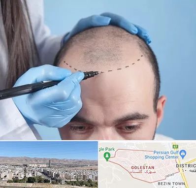 کاشت مو اقساطی در شهرک گلستان شیراز