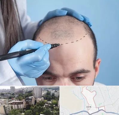 کاشت مو اقساطی در اوین