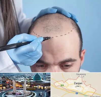 کاشت مو اقساطی در زنجان