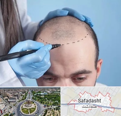 کاشت مو اقساطی در صفادشت