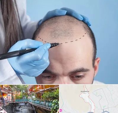 کاشت مو اقساطی در درکه