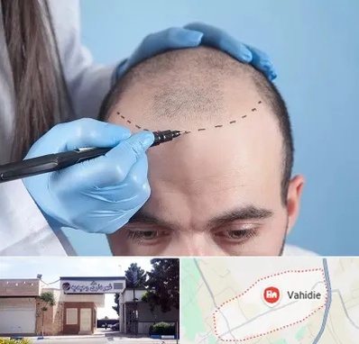 کاشت مو اقساطی در وحیدیه شهریار