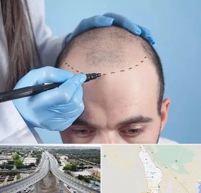 کاشت مو اقساطی در اندیمشک