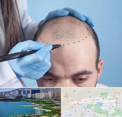 کاشت مو اقساطی در منطقه 22 تهران 