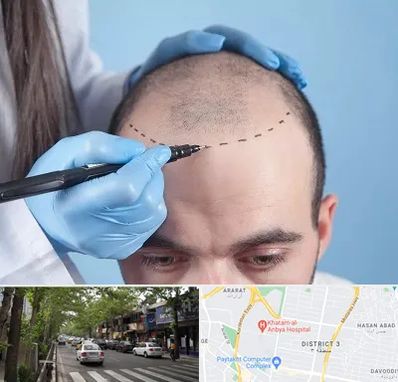 کاشت مو اقساطی در ظفر 