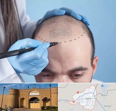 کاشت مو اقساطی در ایرانشهر