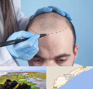 کاشت مو اقساطی در بندرلنگه