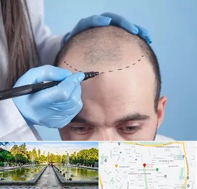 کاشت مو اقساطی در سرسبز 