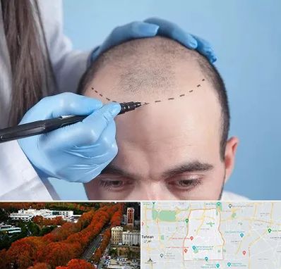 کاشت مو اقساطی در منطقه 6 تهران 