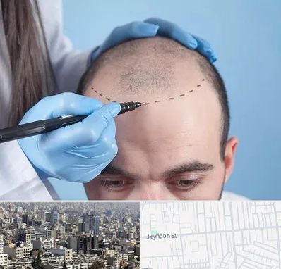 کاشت مو اقساطی در جیحون