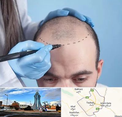 کاشت مو اقساطی در تایباد