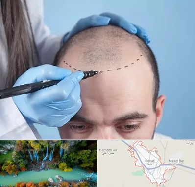 کاشت مو اقساطی در دورود