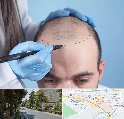 کاشت مو اقساطی در مهرویلا کرج