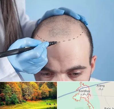 کاشت مو اقساطی در کردکوی