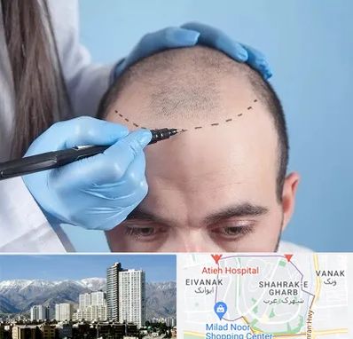 کاشت مو اقساطی در شهرک غرب 