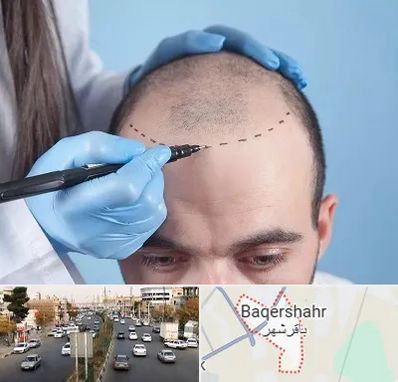 کاشت مو اقساطی در باقرشهر