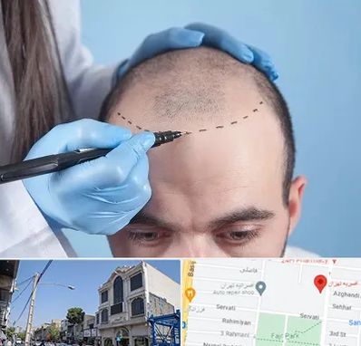 کاشت مو اقساطی در افسریه 