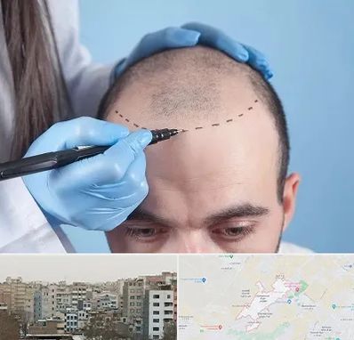 کاشت مو اقساطی در محمد شهر کرج 