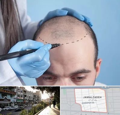 کاشت مو اقساطی در خیابان جمالزاده