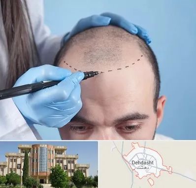کاشت مو اقساطی در دهدشت