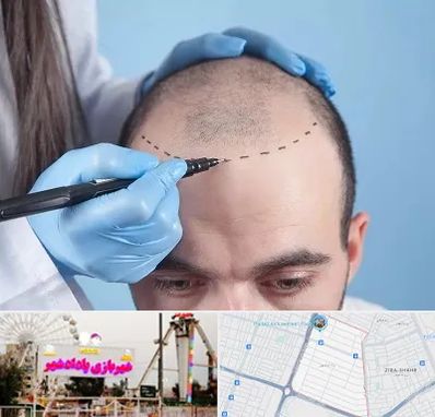 کاشت مو اقساطی در پادادشهر اهواز