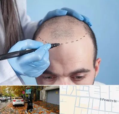 کاشت مو اقساطی در خیابان فلسطین