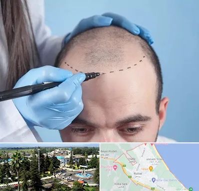 کاشت مو اقساطی در رودسر