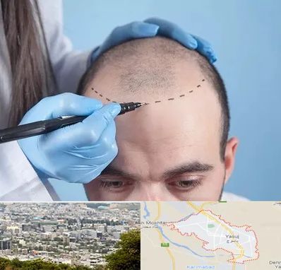 کاشت مو اقساطی در یاسوج