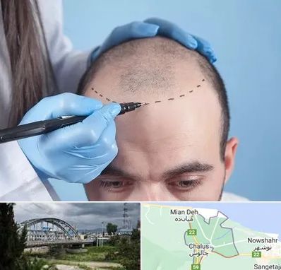 کاشت مو اقساطی در چالوس