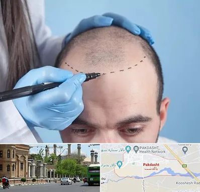 کاشت مو اقساطی در پاکدشت