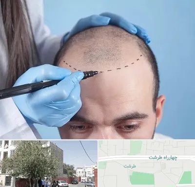 کاشت مو اقساطی در طرشت