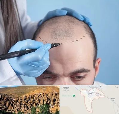 کاشت مو اقساطی در اسکو