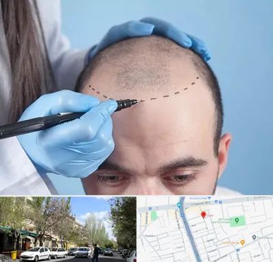 کاشت مو اقساطی در کوی فیروز تبریز