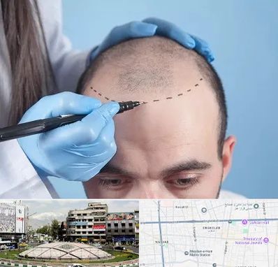 کاشت مو اقساطی در مرکز تهران