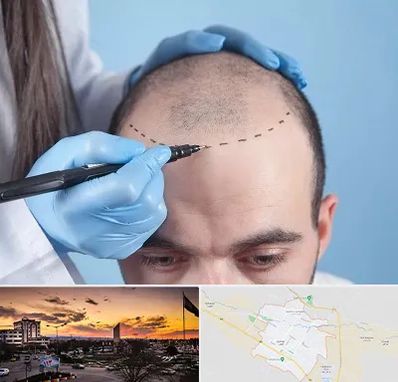 کاشت مو اقساطی در قوچان