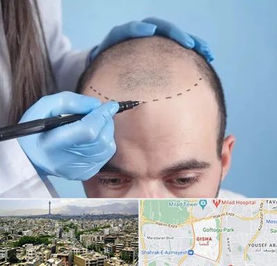 کاشت مو اقساطی در گیشا 