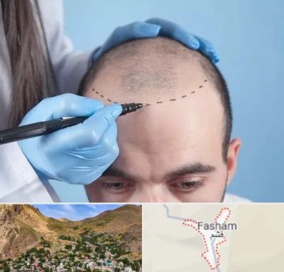 کاشت مو اقساطی در فشم